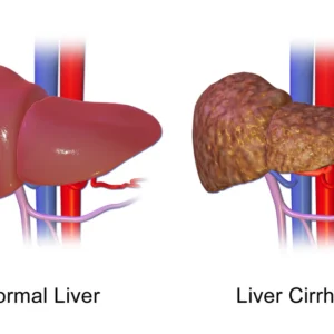 Liver Disease