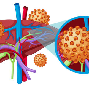 Medical Education: Human Anatomy of Liver with Hepatitis
